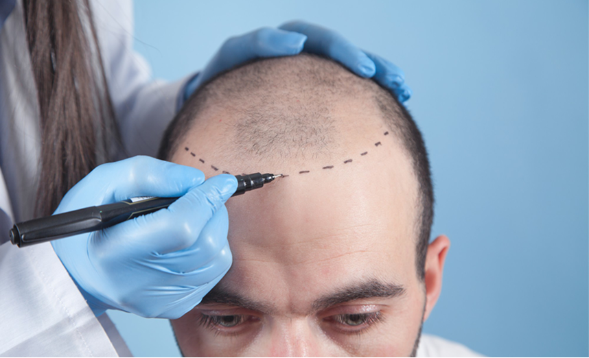 ¿Micropigmentación capilar o cabeza pintada? La diferencia está en quién lo hace.